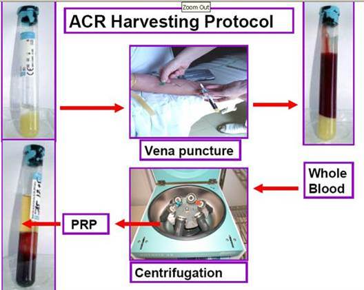 PRP THERAPY
Platelet Rich Plasma (PRP)