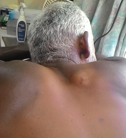 Cyst Removal From Back Pain Less